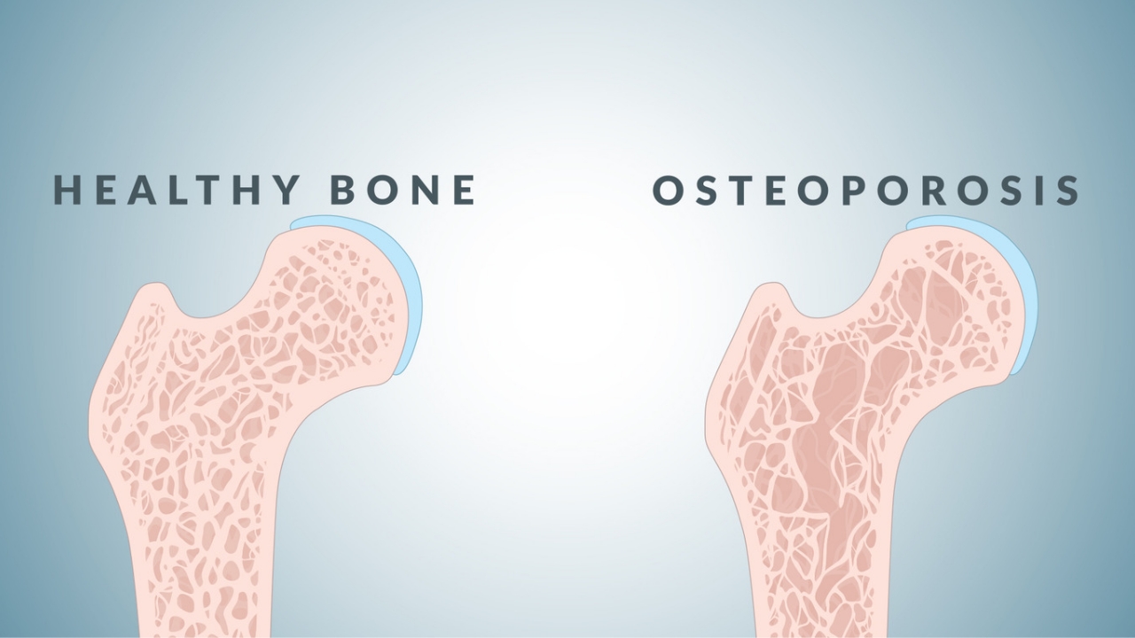 Everything you need to know about osteoporosis | News Makhani | Latest ...