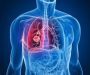 6 Tips to maintain healthy life during, after lung cancer treatment